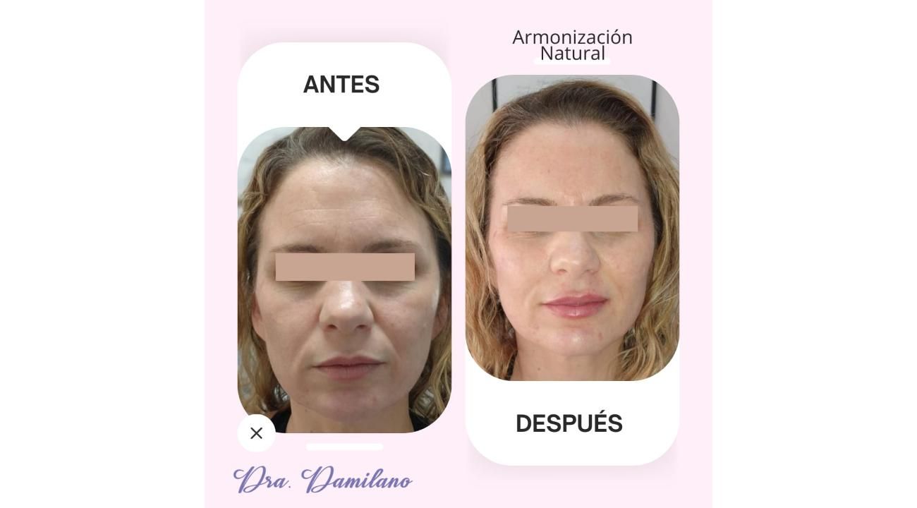 Dra. Gabriela Damilano: Cómo evitar el síndrome de Overfilled Facial y lograr un rejuvenecimiento natural