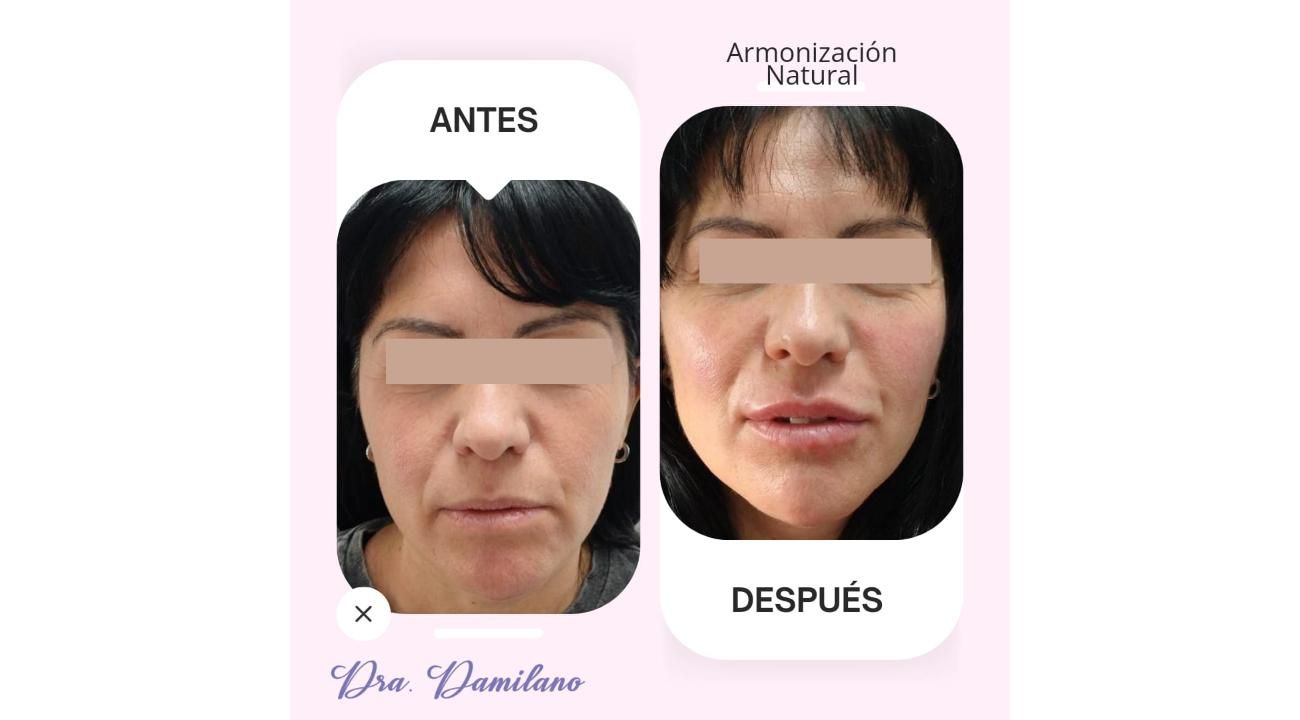 Dra. Gabriela Damilano: Cómo evitar el síndrome de Overfilled Facial y lograr un rejuvenecimiento natural