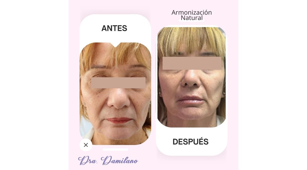 Dra. Gabriela Damilano: Cómo evitar el síndrome de Overfilled Facial y lograr un rejuvenecimiento natural