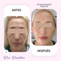 Dra. Gabriela Damilano: Cómo evitar el síndrome de Overfilled Facial y lograr un rejuvenecimiento natural