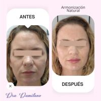 Dra. Gabriela Damilano: Cómo evitar el síndrome de Overfilled Facial y lograr un rejuvenecimiento natural