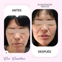 Dra. Gabriela Damilano: Cómo evitar el síndrome de Overfilled Facial y lograr un rejuvenecimiento natural