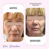Dra. Gabriela Damilano: Cómo evitar el síndrome de Overfilled Facial y lograr un rejuvenecimiento natural