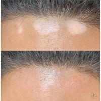 ¿Qué es el Vitiligo? Por Juliana Zanetti