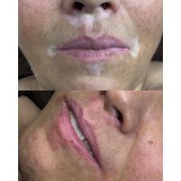 ¿Qué es el Vitiligo? Por Juliana Zanetti