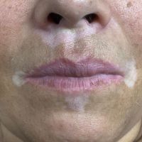 ¿Qué es el Vitiligo? Por Juliana Zanetti