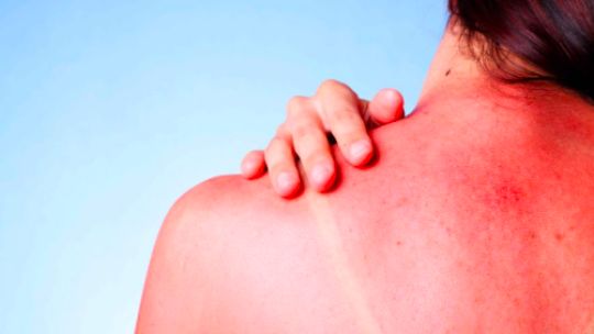 Consejos para cuidar tu piel en verano
