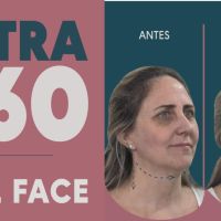 Ultra 360: El Real Lifting sin cirugía