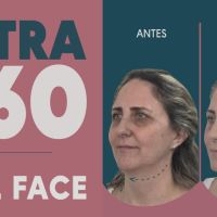 Ultra 360: El Real Lifting sin cirugía
