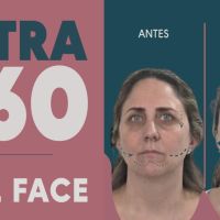 Ultra 360: El Real Lifting sin cirugía