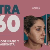 Ultra 360: El Real Lifting sin cirugía
