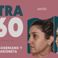 Ultra 360: El Real Lifting sin cirugía