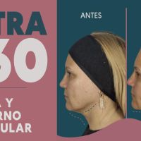 Ultra 360: El Real Lifting sin cirugía