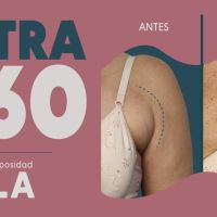Ultra 360: El Real Lifting sin cirugía