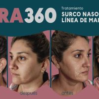 Ultra 360: El Real Lifting sin cirugía