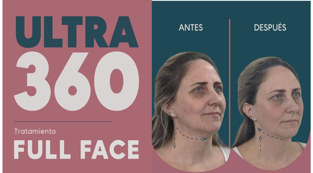 Ultra 360: El Real Lifting sin cirugía
