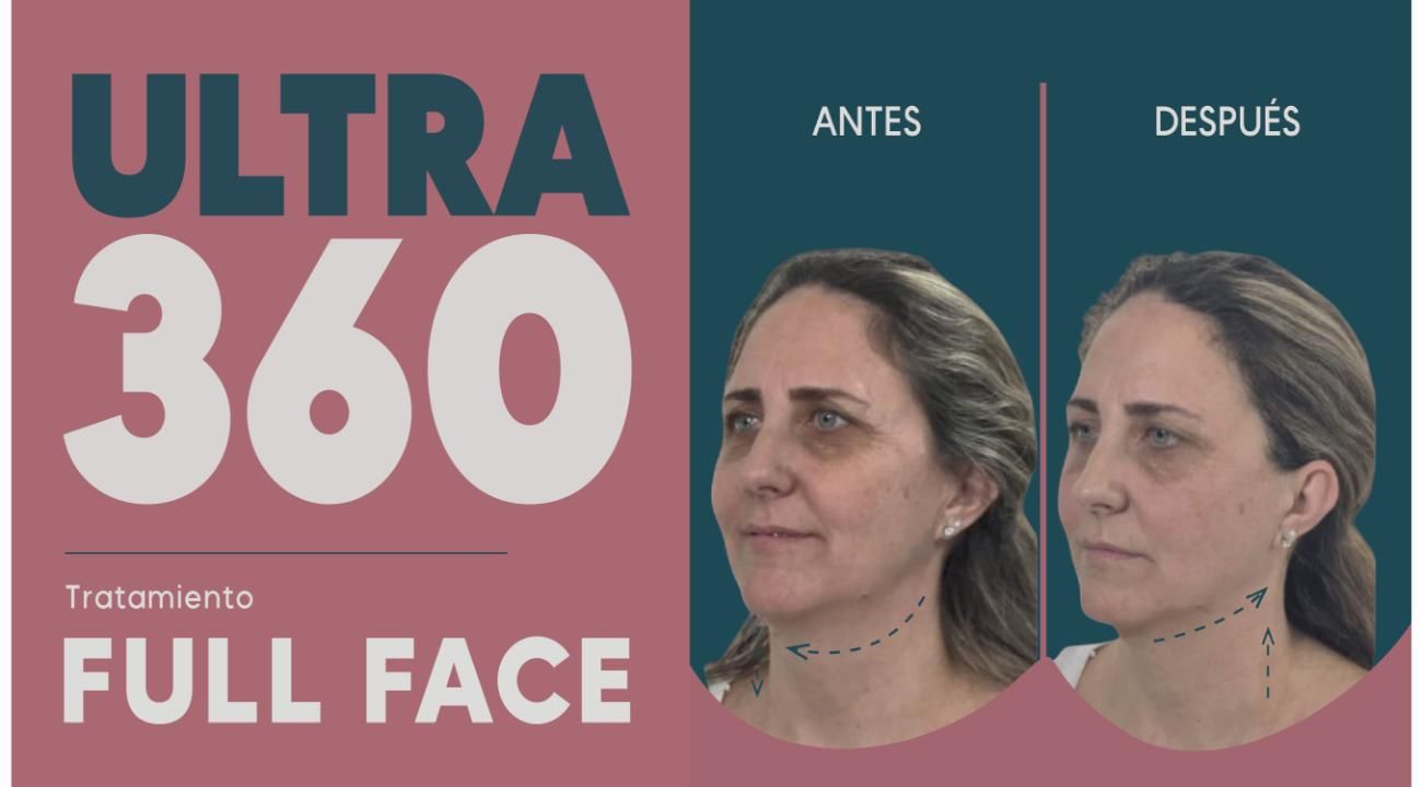 Ultra 360: El Real Lifting sin cirugía