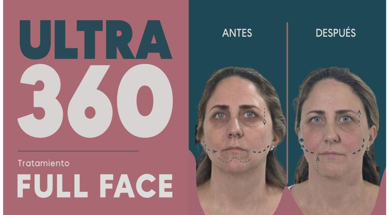 Ultra 360: El Real Lifting sin cirugía