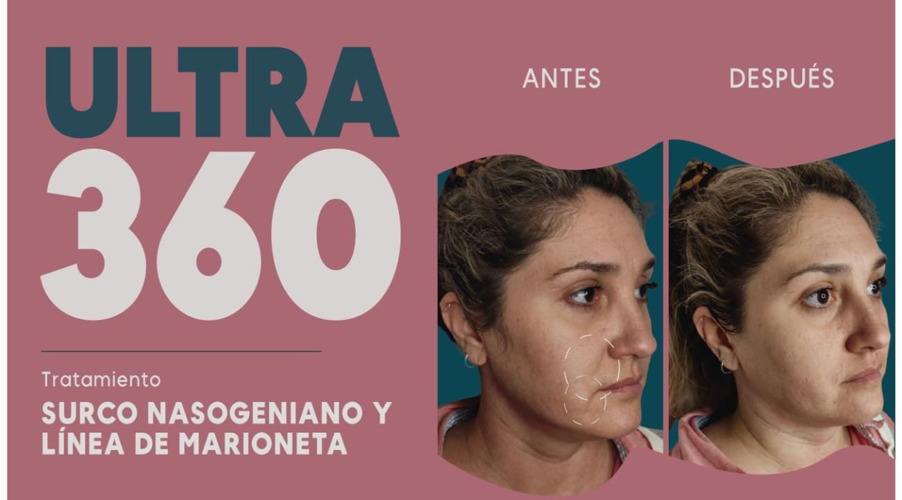 Ultra 360: El Real Lifting sin cirugía