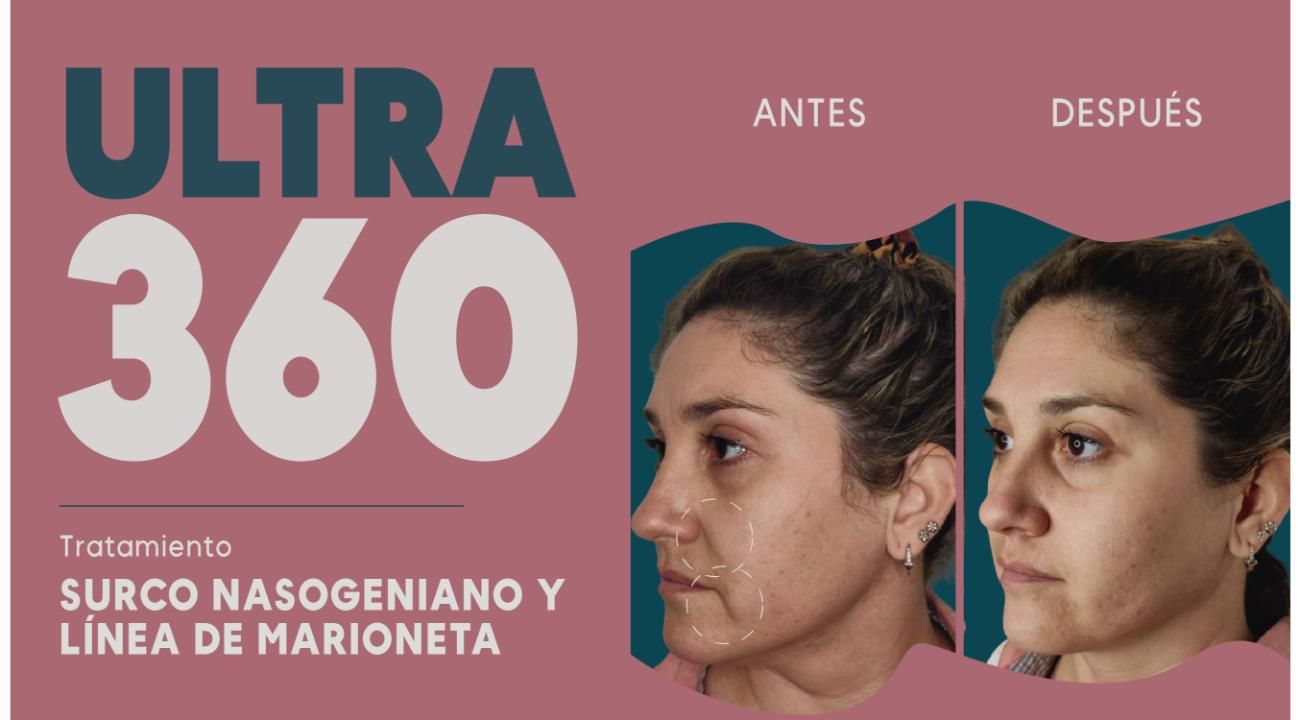 Ultra 360: El Real Lifting sin cirugía