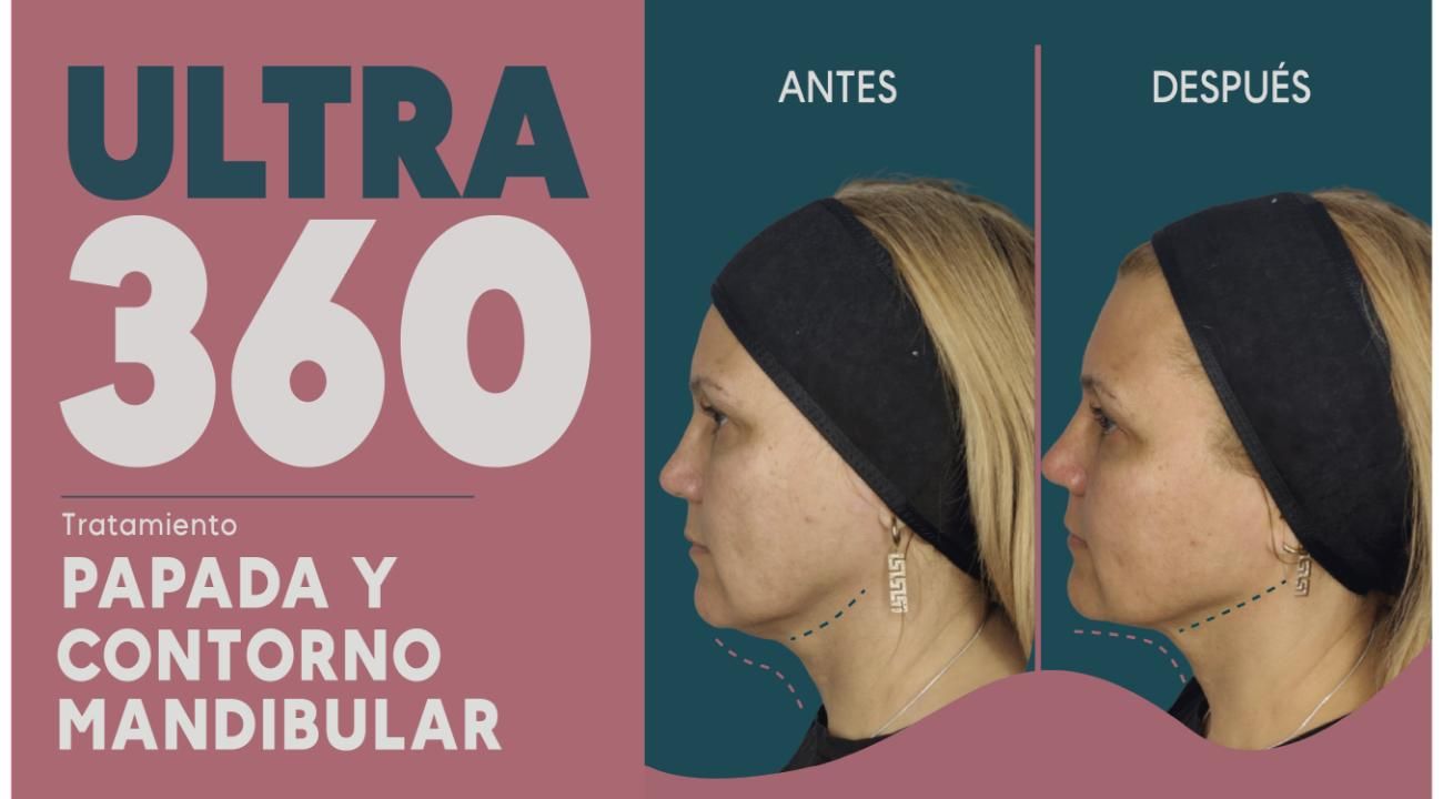 Ultra 360: El Real Lifting sin cirugía