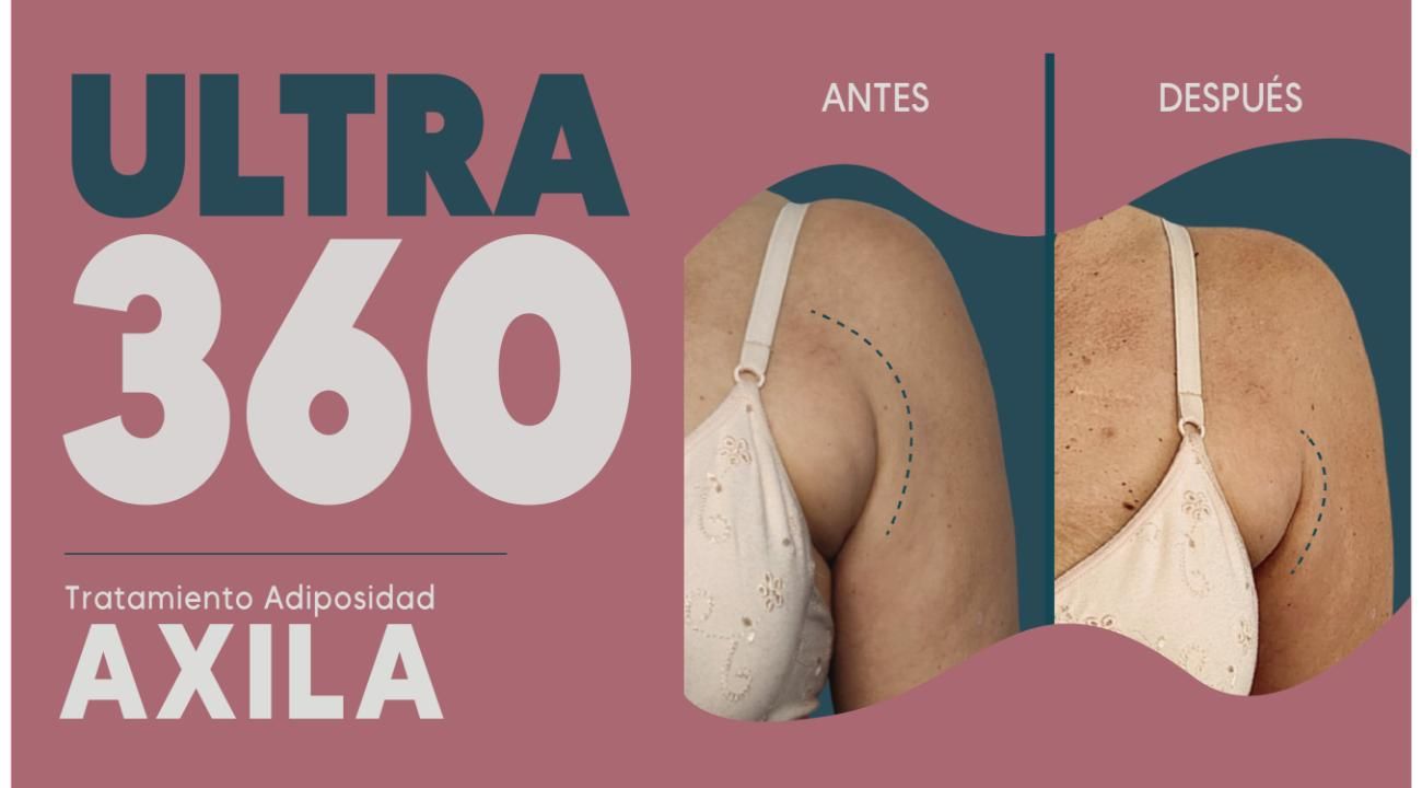 Ultra 360: El Real Lifting sin cirugía