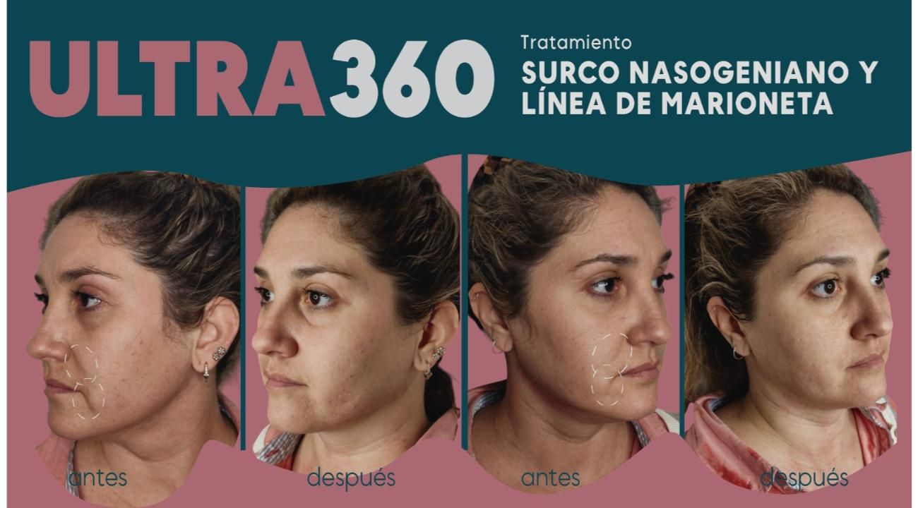 Ultra 360: El Real Lifting sin cirugía