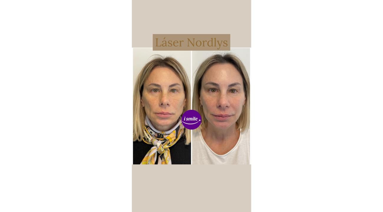 Los Verdaderos Beneficios de la Armonización Facial