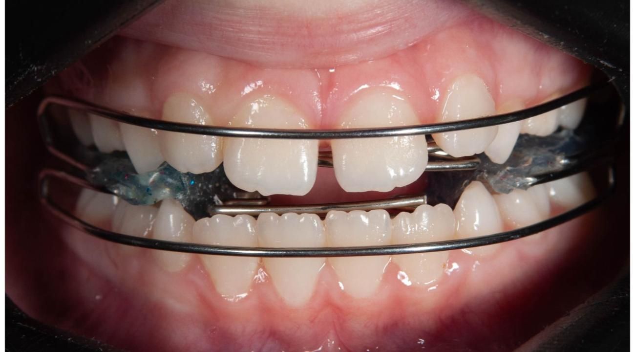 La clave para un óptimo crecimiento facial y una sonrisa perfecta: La ortopedia Maxilar