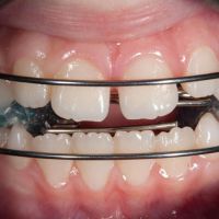 La clave para un óptimo crecimiento facial y una sonrisa perfecta: La ortopedia Maxilar