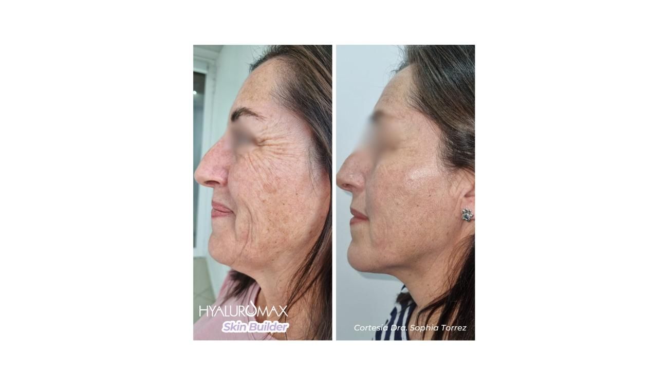 ¿Es tu primera vez con un tratamiento Skin Booster? Guía completa sobre Hyaluromax Skin Builder L 