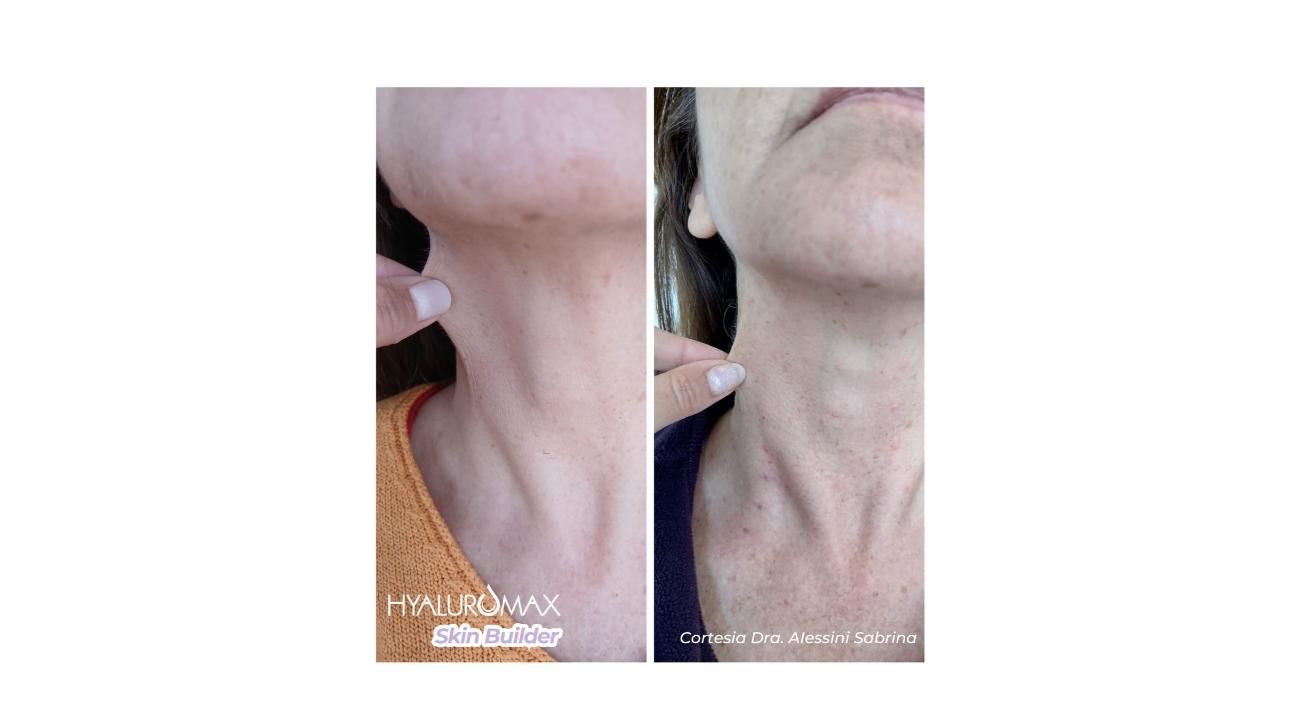 ¿Es tu primera vez con un tratamiento Skin Booster? Guía completa sobre Hyaluromax Skin Builder L 