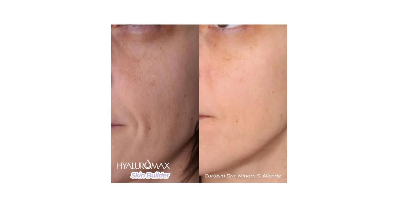 ¿Es tu primera vez con un tratamiento Skin Booster? Guía completa sobre Hyaluromax Skin Builder L 