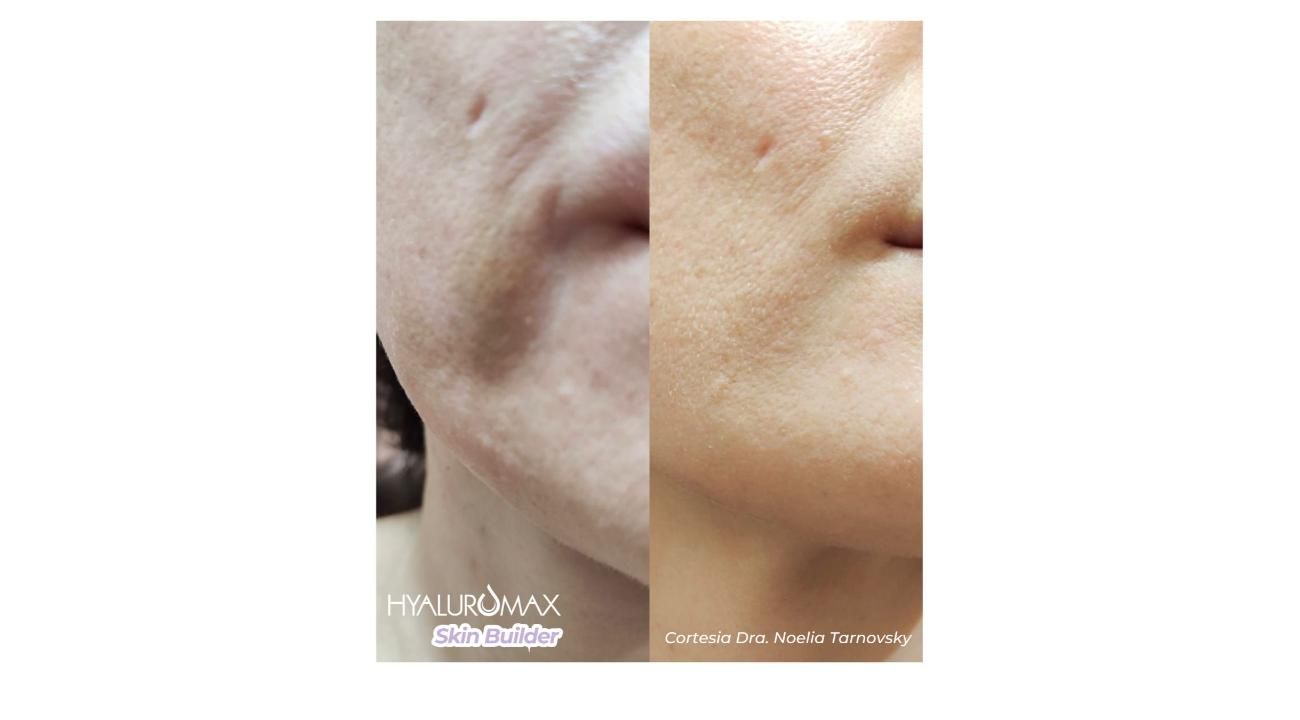 ¿Es tu primera vez con un tratamiento Skin Booster? Guía completa sobre Hyaluromax Skin Builder L 