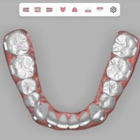 Alineadores dentales: 5 cosas que tenes que saber antes de usarlos.