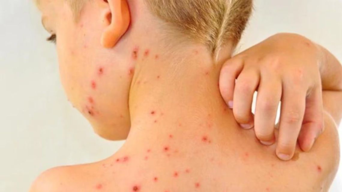 Measles Outbreak Investigation in Argentina: Tourist Family Contacts - News Directory 3