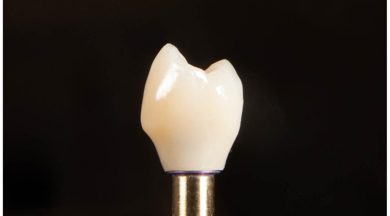 La revolución en implantología dental: cirugía guiada para transformar tu sonrisa