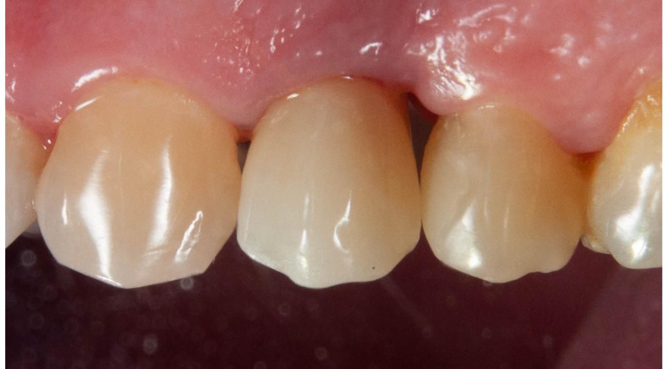 La revolución en implantología dental: cirugía guiada para transformar tu sonrisa