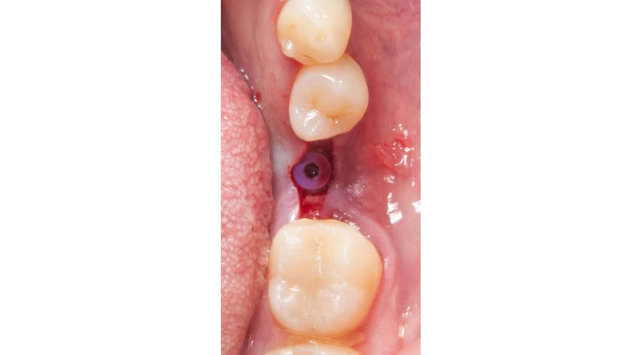 La revolución en implantología dental: cirugía guiada para transformar tu sonrisa