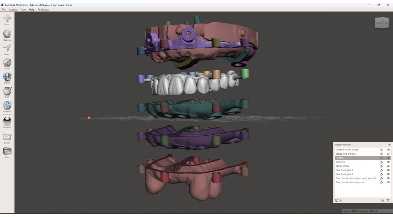 La revolución en implantología dental: cirugía guiada para transformar tu sonrisa