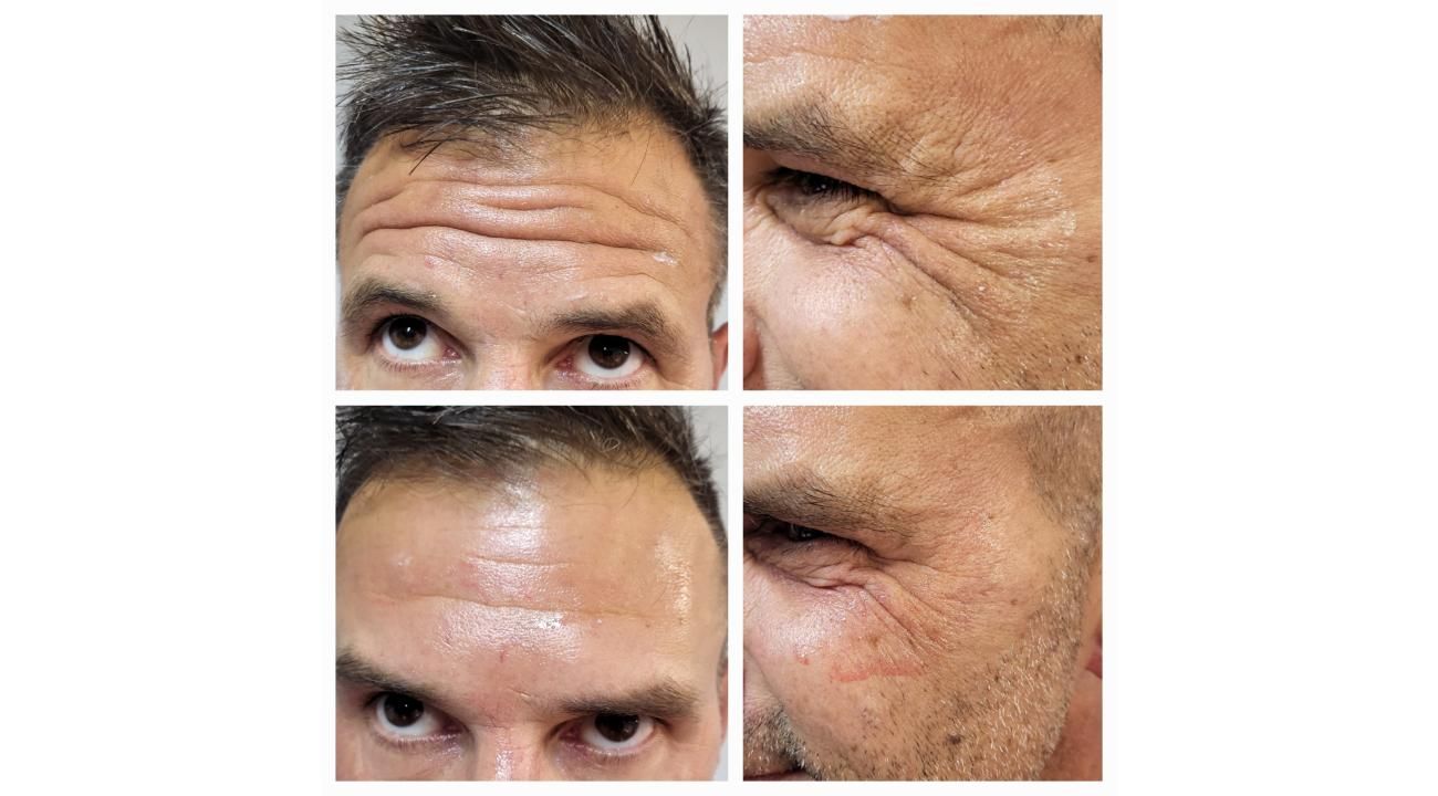 Desmintiendo creencias sobre la toxina botulínica con el Dr. Federico Gansslen.