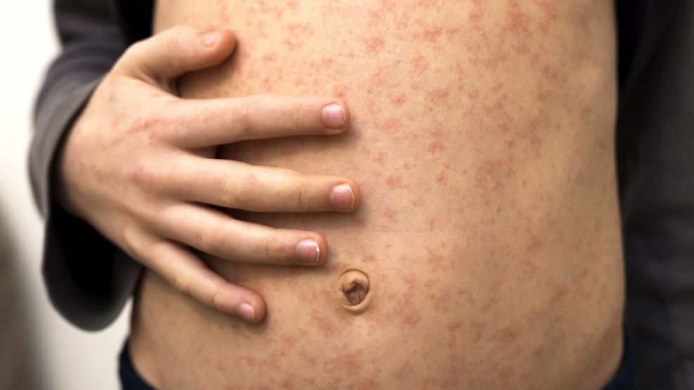 Crece la preocupación por la suba de casos de sarampión: además alertan por paperas y hepatitis A.