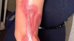 Mujer con el brazo quemado 20250507 