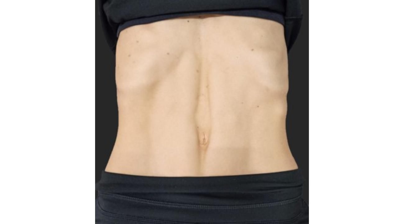Diástasis Abdominal: Un nuevo paradigma para su tratamiento