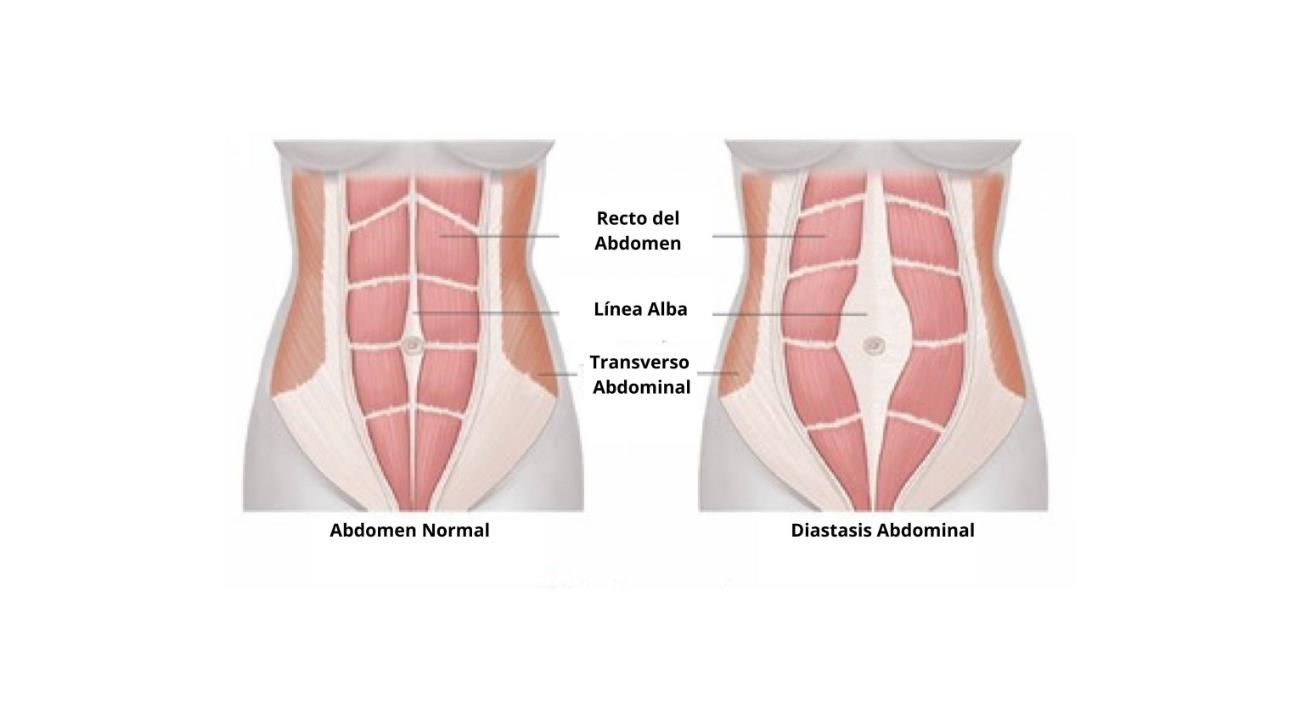 Diástasis Abdominal: Un nuevo paradigma para su tratamiento