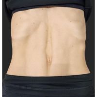 Diástasis Abdominal: Un nuevo paradigma para su tratamiento
