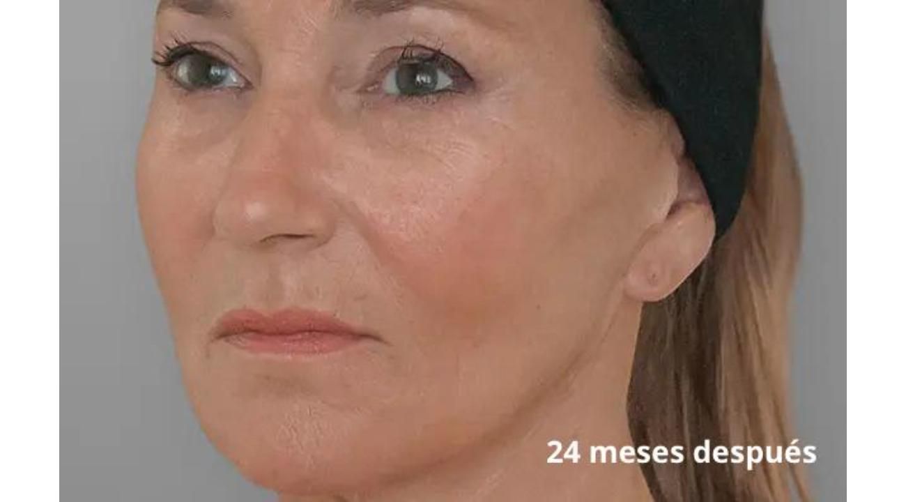 La revolución silenciosa de la piel: bioestimuladores de colágeno