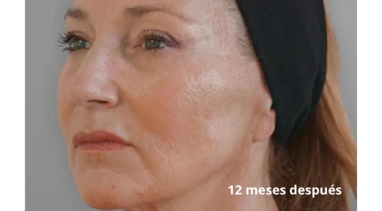 La revolución silenciosa de la piel: bioestimuladores de colágeno