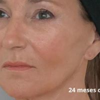 La revolución silenciosa de la piel: bioestimuladores de colágeno