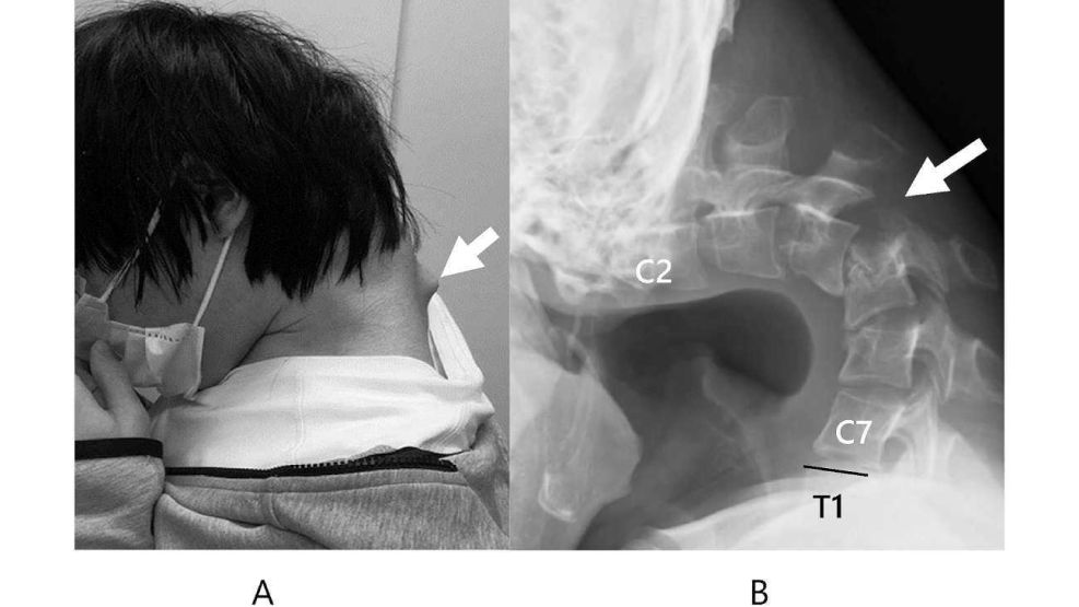Síndrome de cabeza caída 20250514